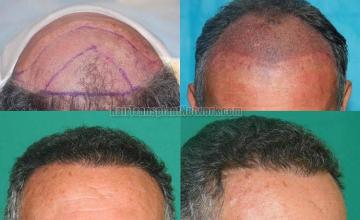 Hair restoration procedure before and after pictures