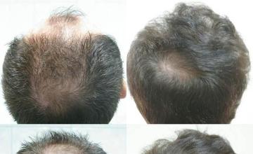 Hair transplant procedure result photographs