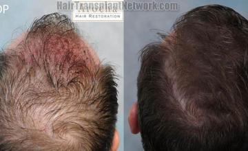 Hair restoration procedure before and after pictures