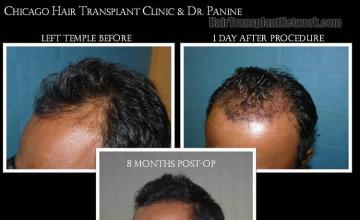 Hair transplantation surgery before and after images