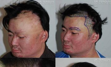 Left  oblique before and after hair restoration on burn victim