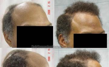 Hair restoration procedure before and after results