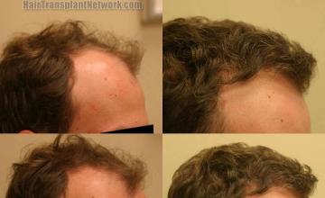 Hair restoration procedure before and after results