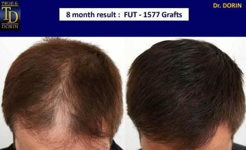 Top view - Before and after hair restoration result