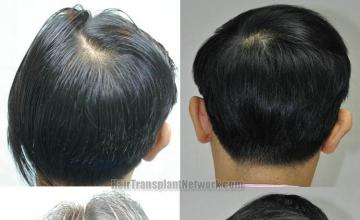 Back view before and after hair transplantation photos