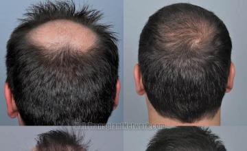 Hair restoration procedure before and after pictures