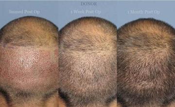 Back view before and after hair transplantation photos