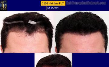 Hair restoration procedure before and after results