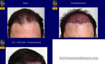 Hair restoration procedure before and after results