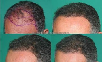 Hair restoration procedure before and after pictures