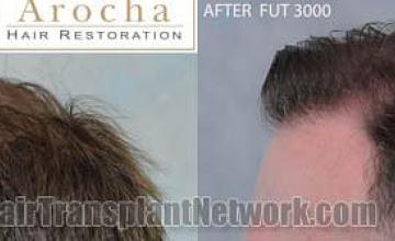 Hair transplantation surgery before and after pictures