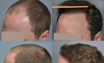 Hair transplantation surgery before and after pictures