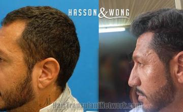 Hair transplantation surgery before and after pictures