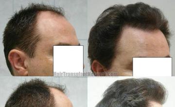 Before and after hair transplantation procedure