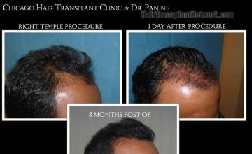 Hair transplantation surgery before and after photos