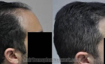 Hair transplantation surgery before and after photos