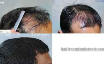 Hair transplantation surgery before and after photos