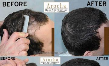 Hair transplantation surgery before and after pictures