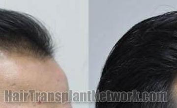 Hair transplantation surgery before and after photos