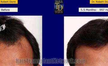 Hair restoration procedure before and after results