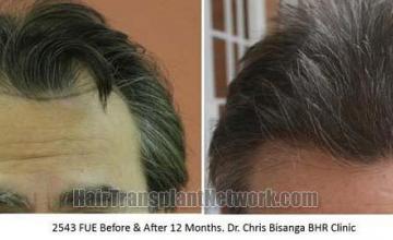 Hair transplantation surgery before and after photos