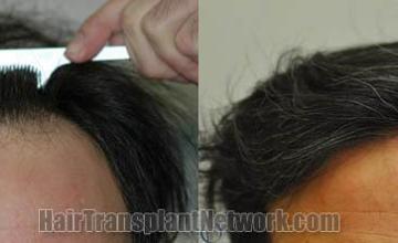 Before and after hair transplant procedure images