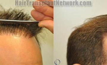 Hair transplantation surgery before and after images