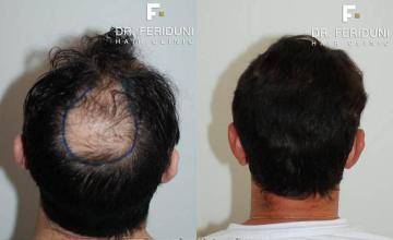 Hair restoration procedure before and after pictures