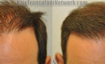 Hair transplantation surgery before and after photos