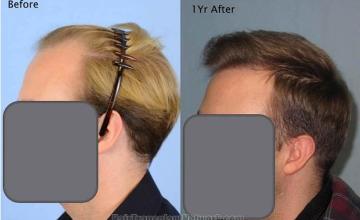 Hair transplantation surgery before and after pictures