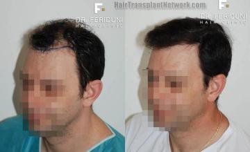 Hair transplantation surgery before and after pictures