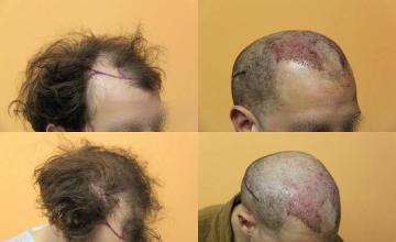 Hair transplantation surgery before and after images