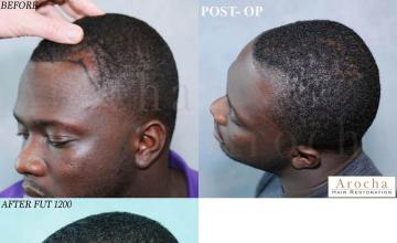 Hair transplantation surgery before and after images