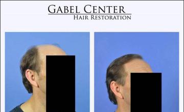 Hair transplantation surgery before and after images