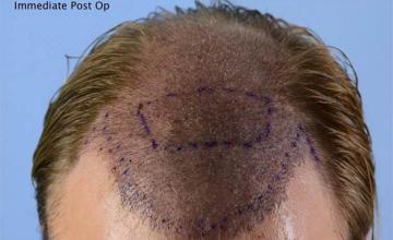 Hair restoration procedure before and after pictures