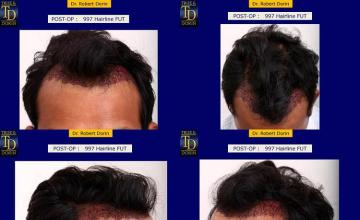 Hair restoration procedure before and after pictures