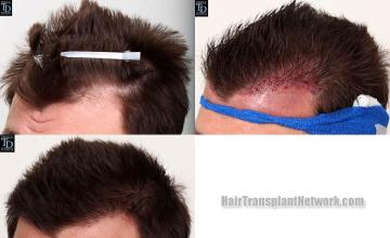 Hair transplantation surgery before and after pictures