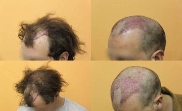 Hair transplantation surgery before and after pictures