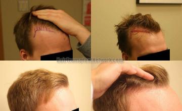 Hair transplantation surgery before and after images