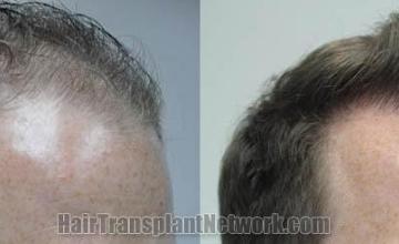 Hair transplantation surgery before and after photos