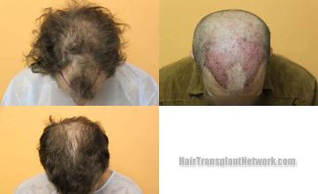 Hair transplantation surgery before and after photos