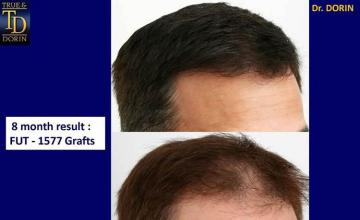 Hair replacement surgery before and after photographs