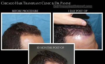 Hair transplantation surgery before and after pictures