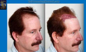 Hair transplantation surgery before and after images