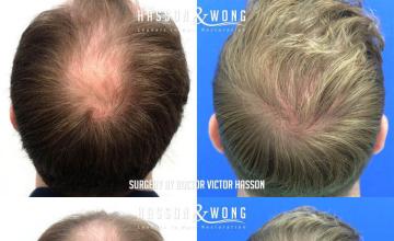 Hair replacement surgery before and after images