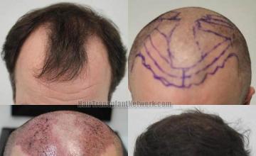 Hair restoration procedure before and after results