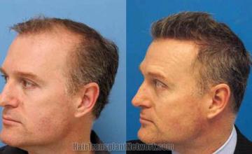 Hair transplantation surgery before and after photos