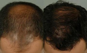 Hair transplantation surgery before and after photos