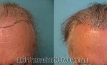 Hair transplantation surgery before and after photos