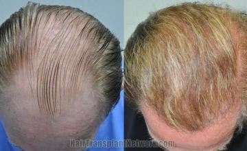 Before and after hair transplant procedure images